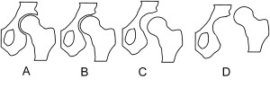 Hip dysplasia schematic